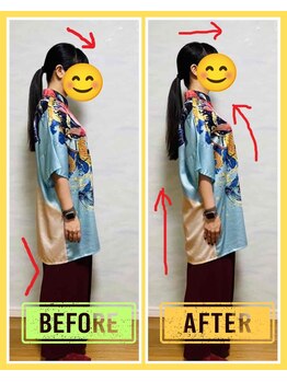 やくいん整骨院 薬院店/姿勢ビフォーアフター