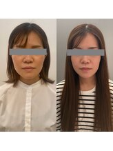 クレファ(CREFA)/美顔整骨