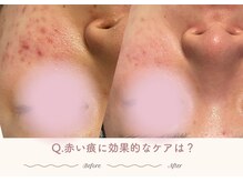 エステティックサロン シーズ/Q.赤い痕に効果的なケアは？
