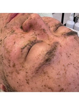 クラルテアンドコー(Salon Clarte&Co.)/ILLON◎海洋性ハーブピーリング