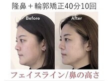 ラプリボヤージュ 藤沢店(Raplit)/ 隆鼻＋輪郭矯正40分
