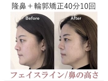 ラプリボヤージュ 藤沢店(Raplit)/ 隆鼻＋輪郭矯正40分