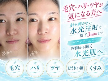 エクラ 六本木(eclat)の写真/【韓国女優水光肌へ】毛穴洗浄×ピーリング×高圧エアで高濃度エクソソームを皮下3mm導入ダウンタイムなし