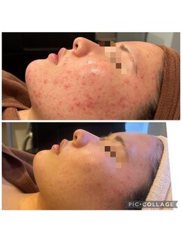 サロン ド フェイス モアナ(Salon de Faith Moana)/フォト光フェイシャル症例