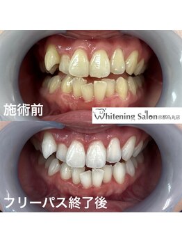 ホワイトニングサロン 京都烏丸店/ホワイトニング施術例