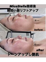 煌(kirameki)/【感動毛穴洗浄】肌改善コース