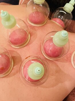 ジェイペック鍼灸整骨院/吸い玉/カッピング