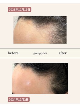 スカルプラボ(Scalp Lab)/moumitu12ヶ月症例