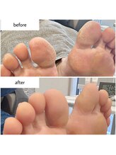 ケアプラス(care plus)/足裏角質ケア