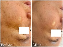 サロンドフェイス(Salon de Faith)/ハーブピーリング