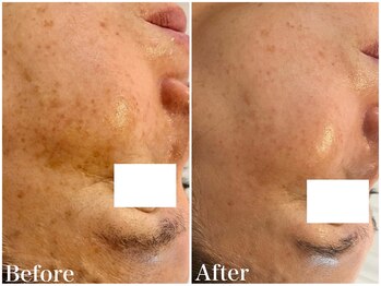 サロンドフェイス(Salon de Faith)/ハーブピーリング