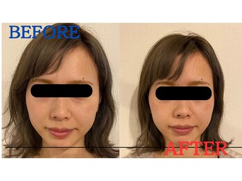 たかす整骨院/小顔/浮腫み/顔の歪み/左右差