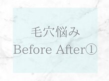 ネオファースト(NeoFirst)/毛穴のビフォーアフターをご紹介