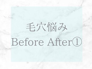 ネオファースト(NeoFirst)/毛穴のビフォーアフターをご紹介