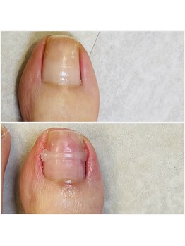 自爪に優しい自然な巻き爪ケア