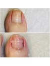 自爪に優しい自然な巻き爪ケア