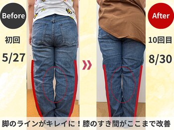 スロース鍼灸整体院(SLOTH鍼灸整体院)/OО脚の改善例