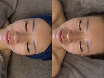 スウィート リリー(Sweet Lily)/エステ版ダーマ