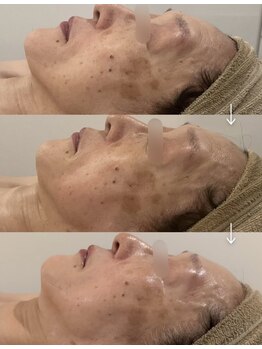 ニコリー(NICOLY)/メラニン排出促進光フェイシャル