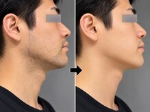 ボディステップ 調布(BODYSTEP)の雰囲気(頬/アゴ/顔/脱毛)