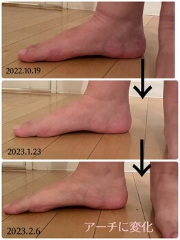 ココン フワット(cocon fouato)/足指矯正！４か月でアーチに変化