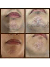 リアンジュ/ひげ脱毛の経過