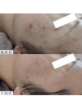 ヴェルシック(Belchic)/根気強く続けることで叶う美肌