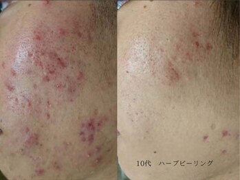 ボタニック 福津店(BoTANiC)/【ハーブピーリング】1回/10代