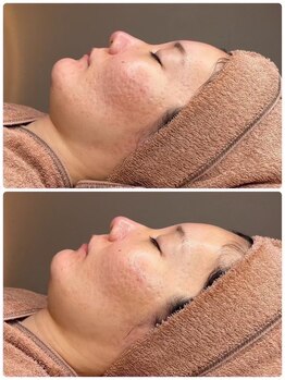 ホリシア 博多(HORISHIA)/ララピール/毛穴/ニキビケア