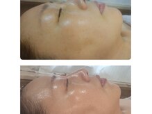 ララピールコース！赤み，シミ，毛穴改善