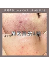 ベルミー(Bellmi)/肌質改善ハーブピーリング(顔)