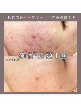 ベルミー(Bellmi)/肌質改善ハーブピーリング(顔)