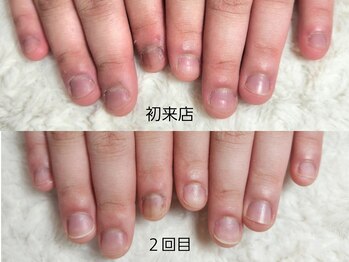 グラシナ なんば店/深爪/自爪育成/フィルイン