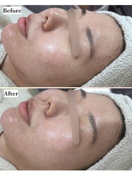 ソワナ(soina)/【神楽坂駅/フェイシャル/毛穴】