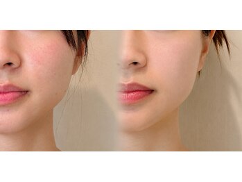 タオ(TAO)の写真/【理想のフェイスラインに】小顔矯正といえばコルギ♪韓国由来の施術でリフトUP◎痛気持ちいいで効果を実感