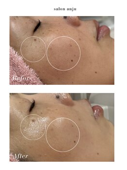 サロン アンジュ(salon.anju)の写真/隠れ毛穴も徹底ケア！ハーブピーリングで理想の透明美白肌を叶えるエステ◎（40文字）