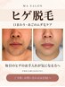 【メンズ】髭脱毛(白髪にも効く)¥7,700→¥4,620