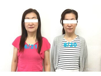 ビューティスタジオＫ/小顔矯正ビフォーアフター