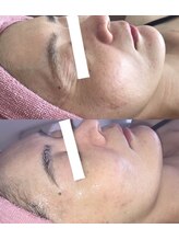 ヴィーナス(Venus)/白玉スキンハーブピーリング