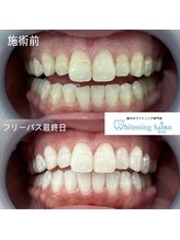 ホワイトニングサロン 熊本店/セルフホワイトニング