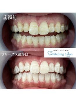 ホワイトニングサロン 熊本店/セルフホワイトニング