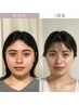 小顔モニターモデル応募の方専用!【こいずみ対応】