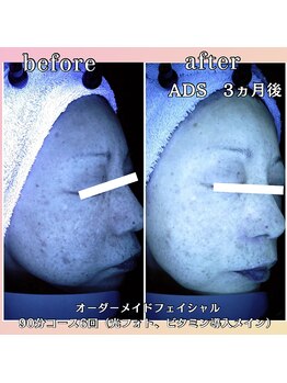 プリマジュール/隠れシミに働きかける！