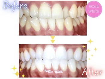 エクシアホワイトニング 西条店/ビフォーアフター