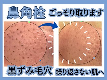 毛穴屋