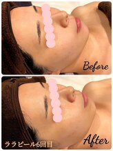 トゥーバイトゥー(TWO BY TWO)/ララピール6回目のお客様