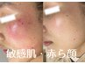 《敏感肌ハーブ》敏感赤ら顔も安心のハーブピーリングで肌質改善＋土台強化◎