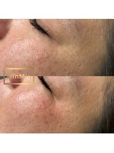 リア プラスマウナ(Li'a +MAUNA)/パーツWax 目の周り