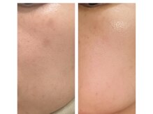 リムビューティー 自由が丘(RymBeauty)/お肌のシミケアやくすみにも