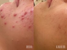 ウォーム(warm)/【肌質改善専門店warm】肌質改善